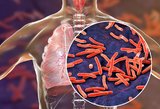 Tuberkulioze užsikrėtę kone trečdalis, tačiau apie tai nė nenutuokia: įvardijo pavojingus požymius