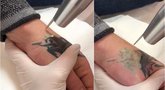 Tatuiruotės šalinimas (tv3.lt fotomontažas)