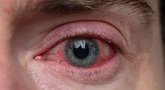 Raudonos akys  (nuotr. Shutterstock.com)
