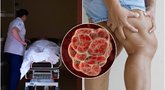 Mirtinus kraujo krešulius išduoda šie ženklai: pastebėkite laiku (nuotr. Shutterstock.com)