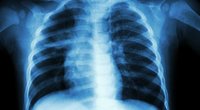 Plaučių vėžį išduoti gali 2 ženklai akyse: nedelsdami kreipkitės į gydytojus (nuotr. 123rf.com)