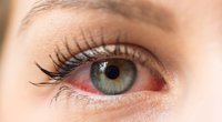 Akių ligos (nuotr. Shutterstock.com)