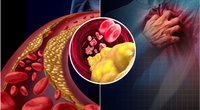 Aukštu cholesteroliu susirūpinkite laiku: gydytoja atskleidė, kokie ženklai jį išduoda (nuotr. tv3.lt)