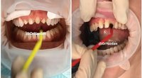Dantų pokyčiai (nuotr. Instagram)