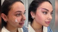  Moteris prieš procedūrą ir po jos (nuotr. Instagram)