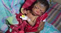 Bangladeše gimė kūdikis „senolio veidu“ (nuotr. YouTube)