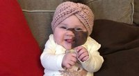 Didžiulį apgamą ant veido turinčios mergaitės mama apie operaciją negalvoja: „Ji tik dar gražesnė“ (nuotr. facebook.com)