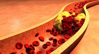 Aukštą cholesterolio kiekį išduoda 3 ženklai: pastebėkite laiku (nuotr. 123rf.com)