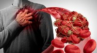 Kraujo krešulius išduoda vos keli ženklai: pastebėkite laiku (nuotr. Shutterstock.com)