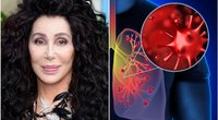 Legendinei atlikėjai Cher smogė mirtina infekcija: skubiai įspėja kitus (tv3.lt fotomontažas)