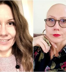 Kaunietė neteko visų savo plaukų per 2 savaites: „Ne, tai ne vėžys"