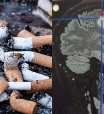 Rūkymo žala smegenims (nuotr. SCANPIX)