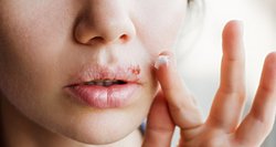 Gydytoja perspėja: lūpų pūslelinė praneša apie organizmo patiriamą stresą