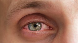 Paraudusios akys (nuotr. Shutterstock.com)