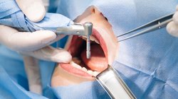 Dantų implantai  