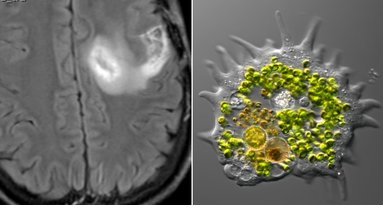 Smegenis naikinanti ameba (nuotr. SCANPIX) tv3.lt fotomontažas
