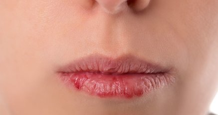Sausos lūpos (nuotr. 123rf.com)