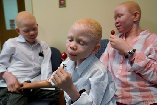 Albinosams tenka išgyventi pragarą: vaizdai iš ligoninės (nuotr. SCANPIX)
