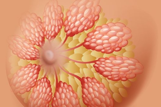 Krūties vėžys  (nuotr. 123rf.com)