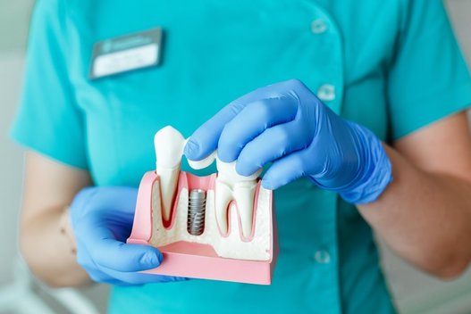 Dantų implantai (nuotr. Shutterstock.com)
