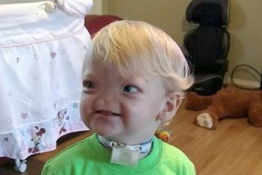 Mažyliai gimė be nosies: vienas atvejis iš milijono (nuotr. YouTube)