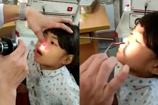 Tai, ką medikai ištraukė iš mergaitės nosies – šokiravo net juos (nuotr. YouTube)