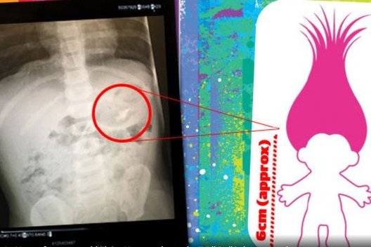 Dvimetė mergaitė vos neužduso nuo žaislo – rentgeno nuotrauka šeimą pribloškė  