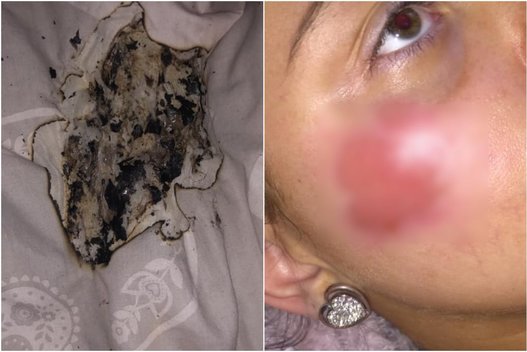 Paauglė skaudžiai nudegė veidą, kai naktį užsidegė jos „iPhone“ įkroviklis (nuotr. facebook.com)