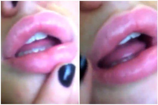 Moteris tenorėjo putlesnių lūpų – patyrė fiasko: rezultatas privers aiktelėti (nuotr. YouTube)
