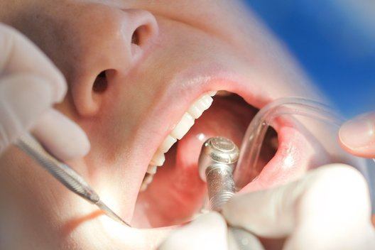 Dantų gydymas (nuotr. 123rf.com)