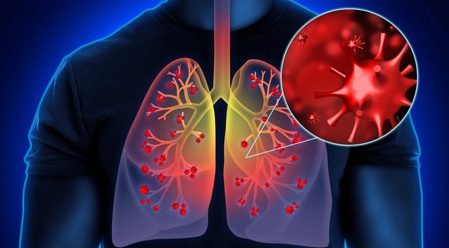 Klastingą plaučių uždegimą išduoda šie ženklai: pastebėkite laiku (nuotr. Shutterstock.com)