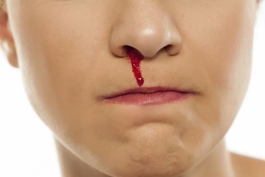 Kraujas iš nosies  (nuotr. 123rf.com)