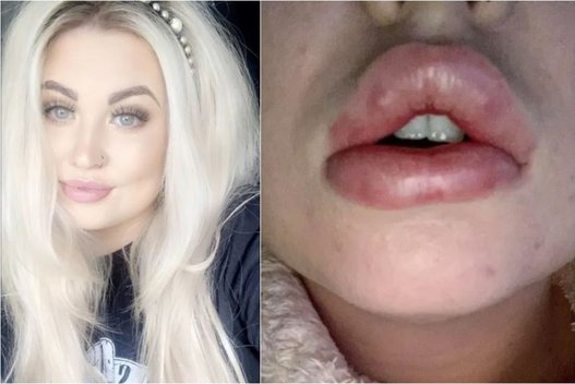 Moteris įspėja dėl lūpų didinimo procedūrų – jai operacija paliko ištinusias lūpas, ligą ir šoką (nuotr. facebook.com)