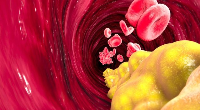 Sumažinkite aukštą cholesterolio kiekį: štai, kas padės (nuotr. Shutterstock.com)