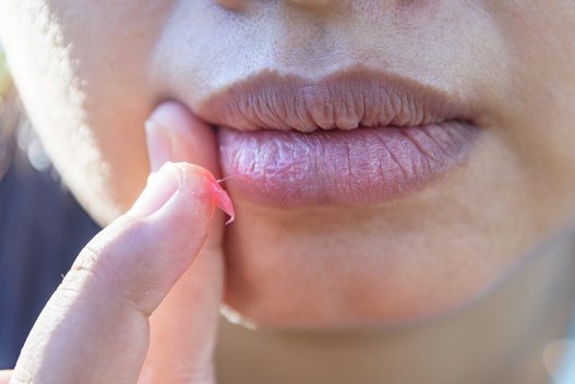 Sausos lūpos  (nuotr. Shutterstock.com)