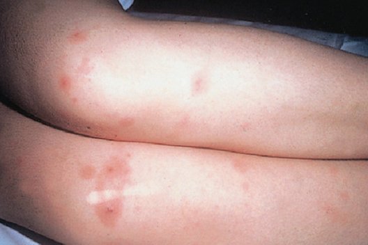 Taip gali atrodyti meningokokinės infekcijos bėrimai ant kūno (ULAC nuotr.) (nuotr. Balsas.lt)
