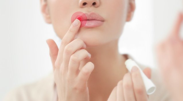 Lūpų pūslelinė (nuotr. Shutterstock.com)