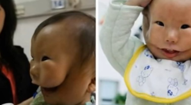 Kinijoje žiniasklaida šį mažylį vadina „vaiku su dviem veidais“.  