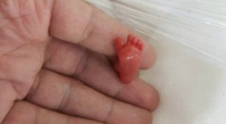 Gydytojai metė nežmoniškas pastangas, kad ją išgelbėtų: tai pirmas toks kūdikis pasaulyje (nuotr. viralthread.com)  