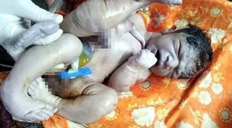 Šis vaikas gimė su keturiomis kojomis, trejomis rankomis ir dvejomis varpomis  