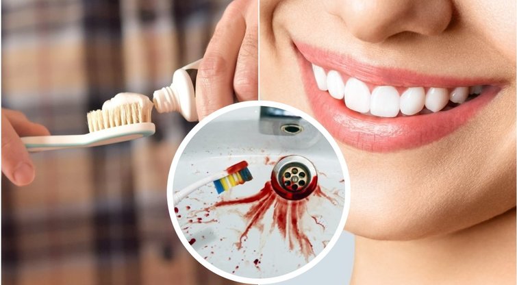 Keturi ženklai parodantys, kad dantis valote per stipriai (tv3.lt fotomontažas)