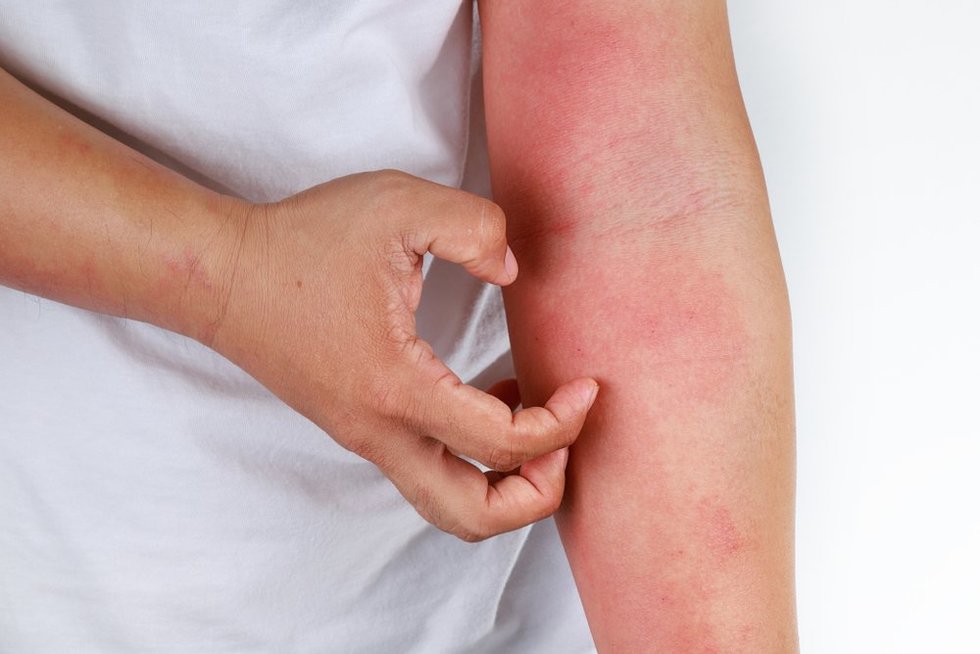 Atopinis dermatitas (nuotr. Shutterstock.com)