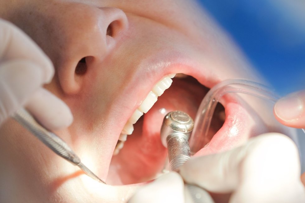 Dantų gydymas (nuotr. 123rf.com)