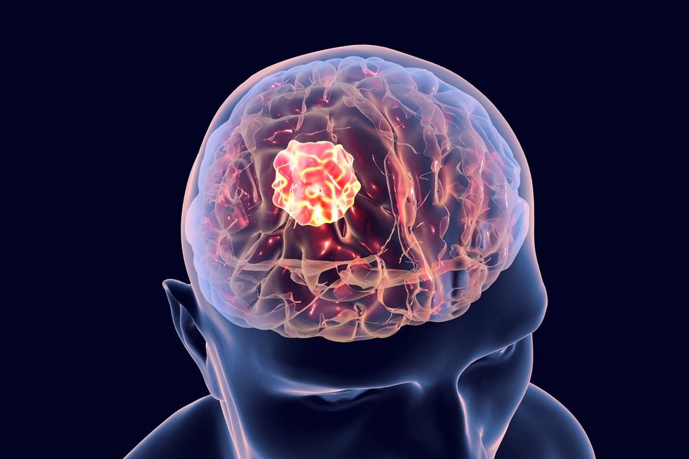 Smegenų vėžys (nuotr. 123rf.com)