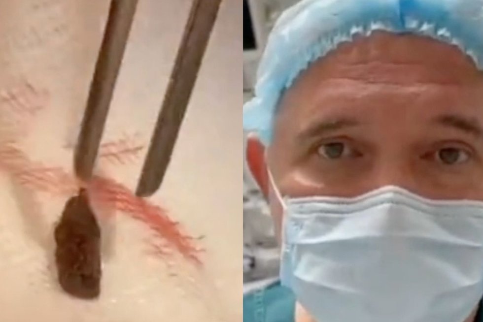 Neįtikėtina: chirurgai Ukrainoje iš plakančios kario širdies sėkmingai pašalino šrapnelį (nuotr. stop kadras)